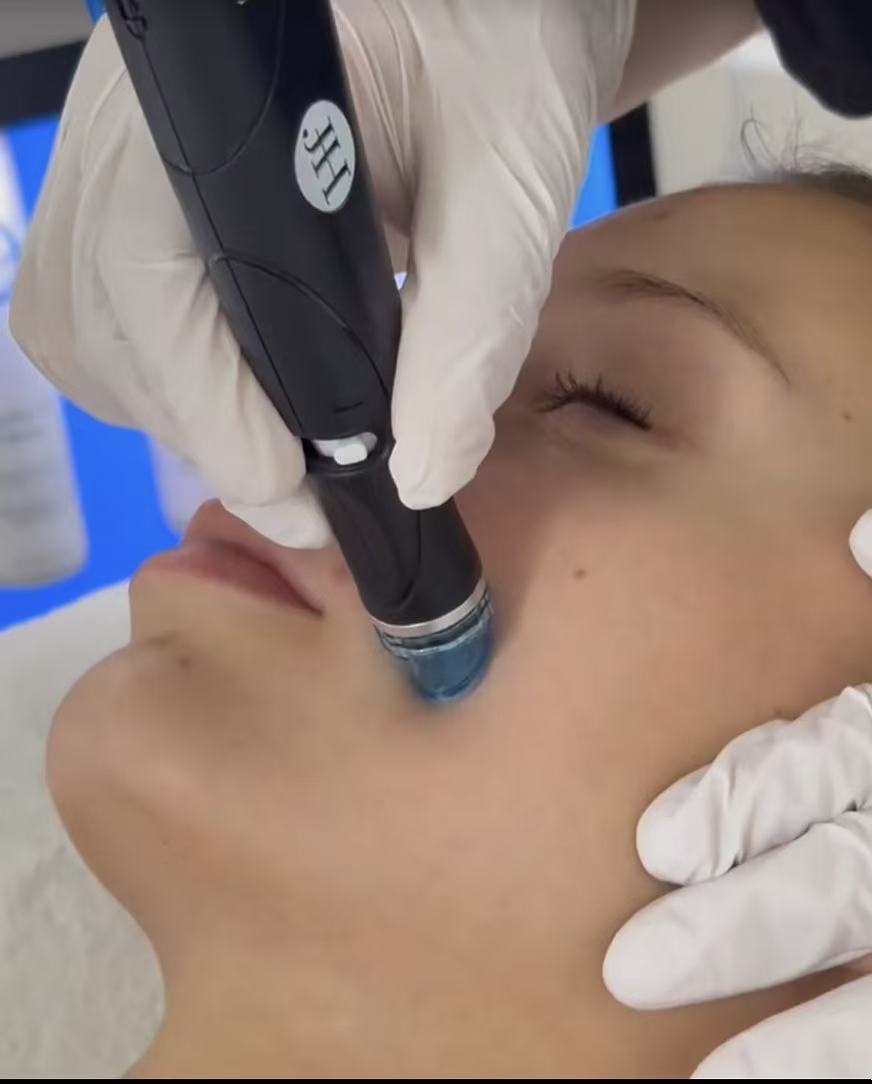 HydraFacial treatment